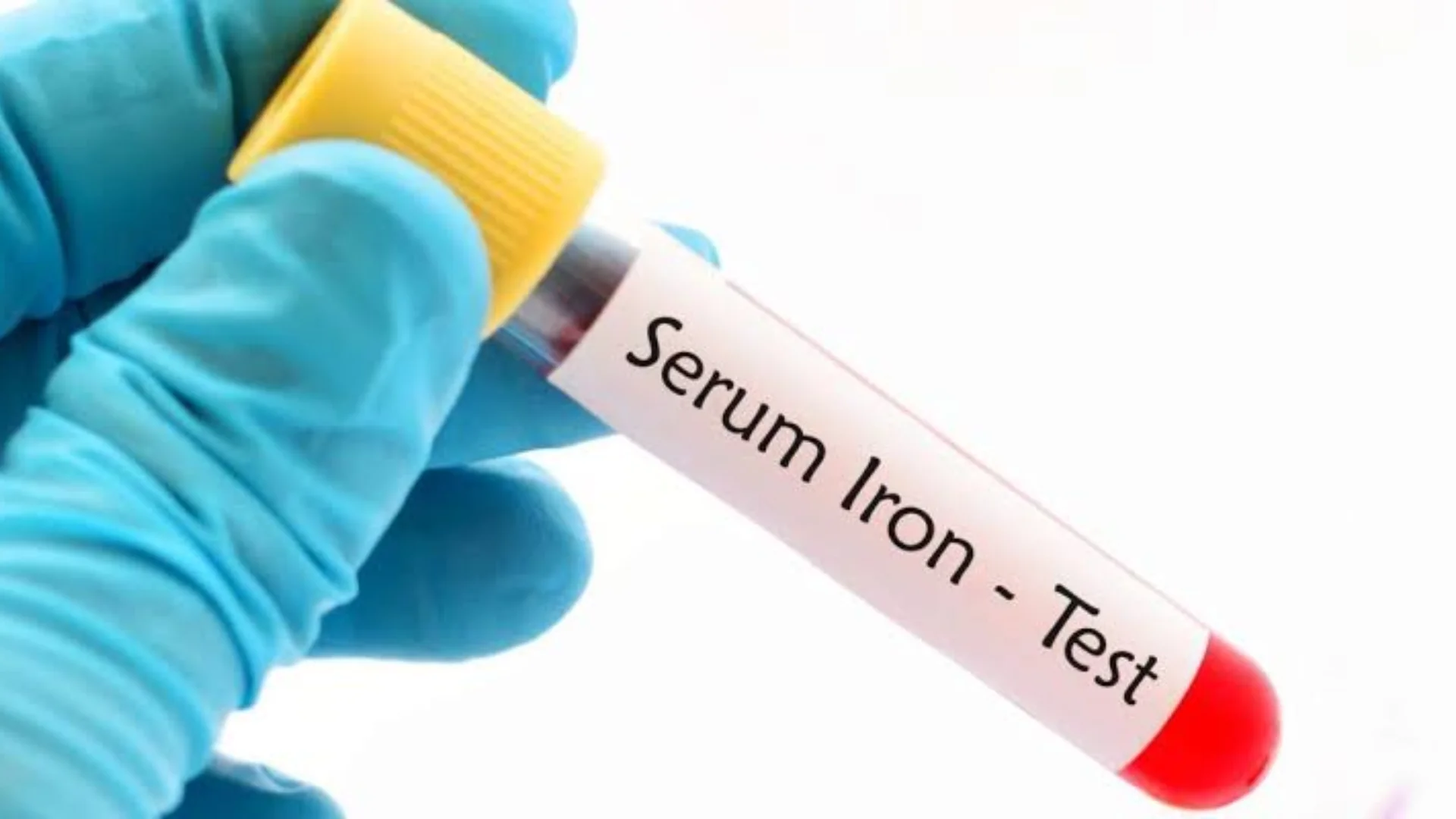 Serum Iron Test